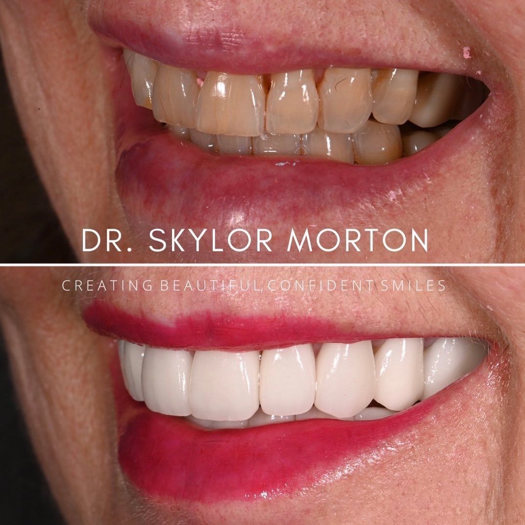 teeth before and after dental treatment
