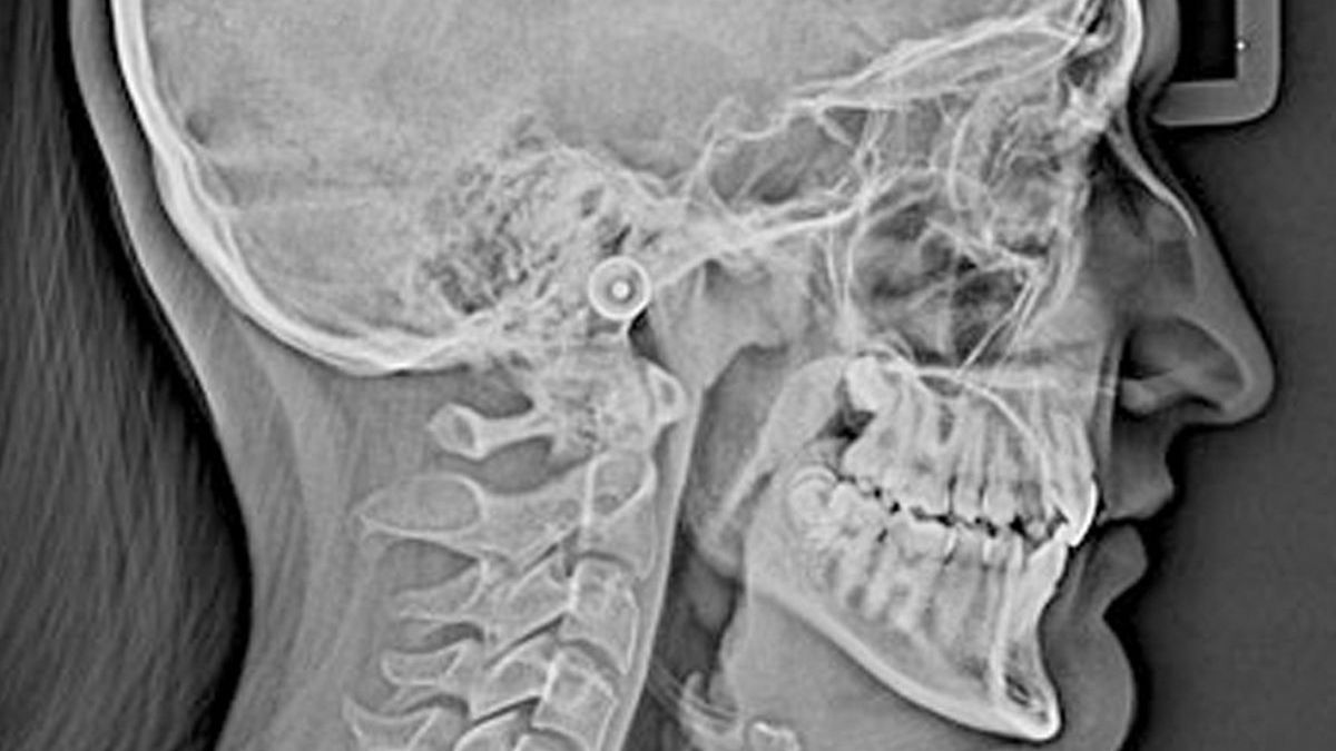 ESTUDIOS CEFALOMÉTRICOS