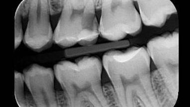 Radiografías intraorales