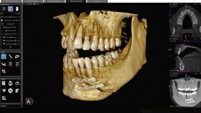 TOMOGRAFÍA COMPUTARIZADA DE HAZ CÓNICO