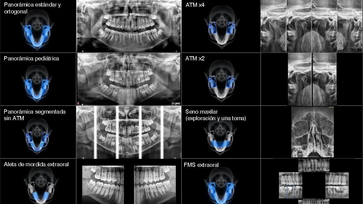 Radiografía ExtraOrales