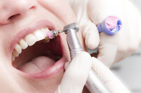 Bei der Professionellen Zahnreinigung wird der gesamte Zahnbelag von Profis entfernt