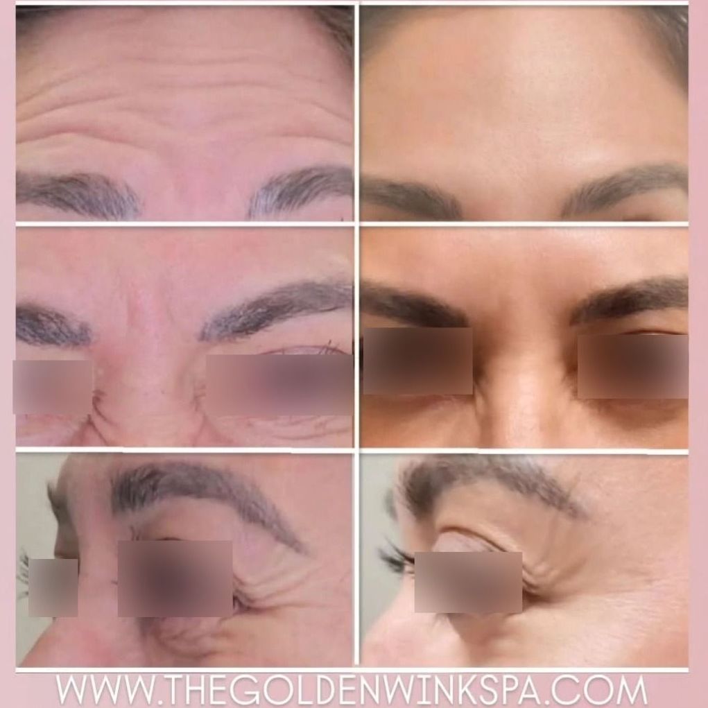 A before and after photo of a woman 's forehead.