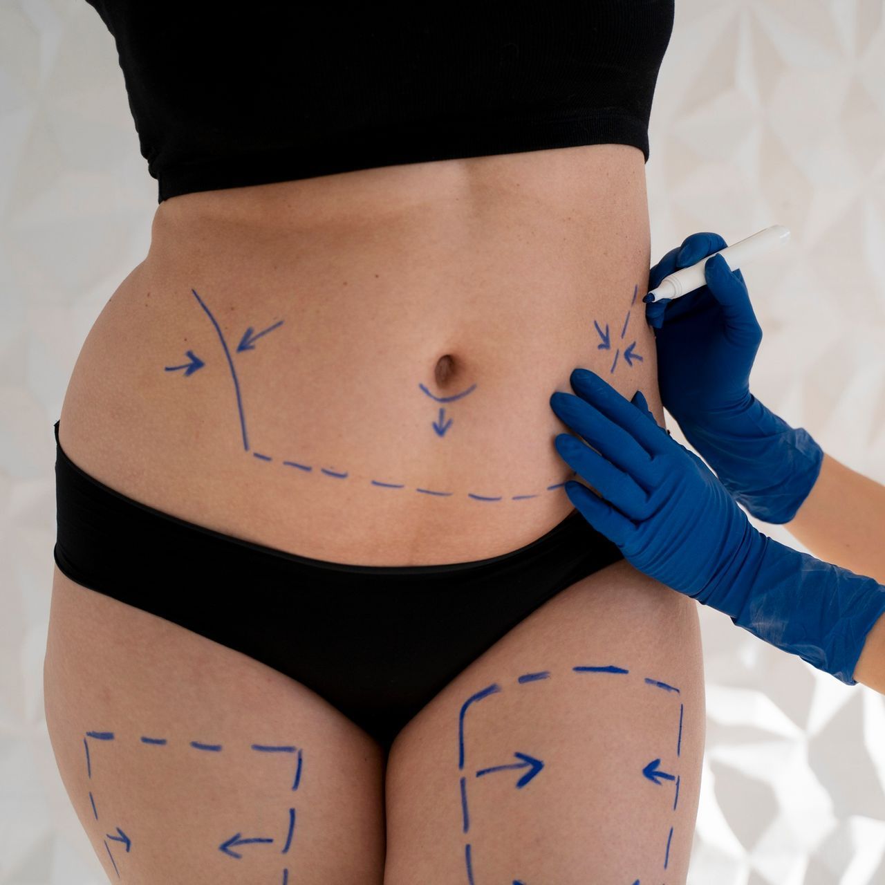 A woman is getting a surgery on her stomach.