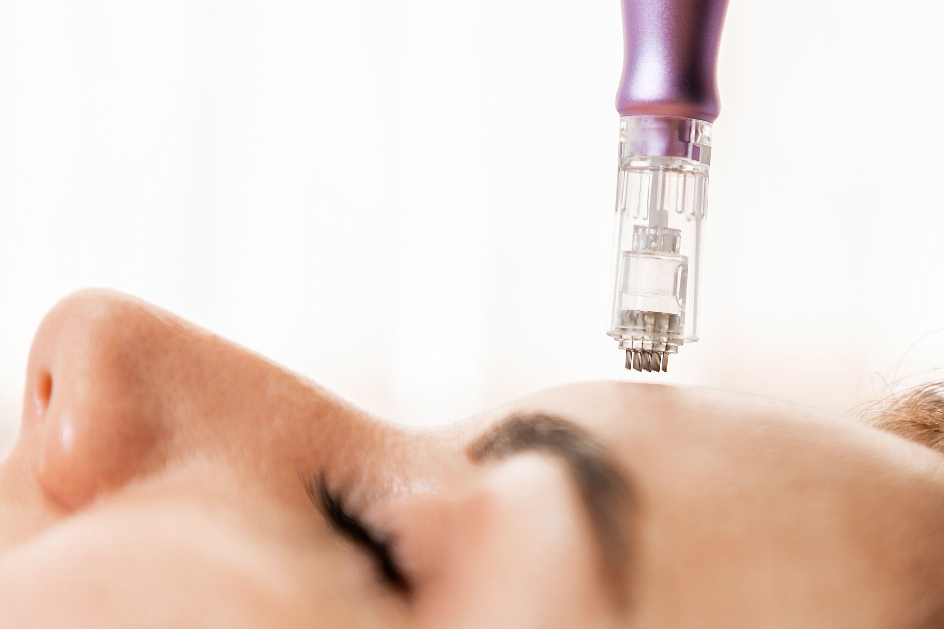 A woman is getting a microneedle treatment on her face.
