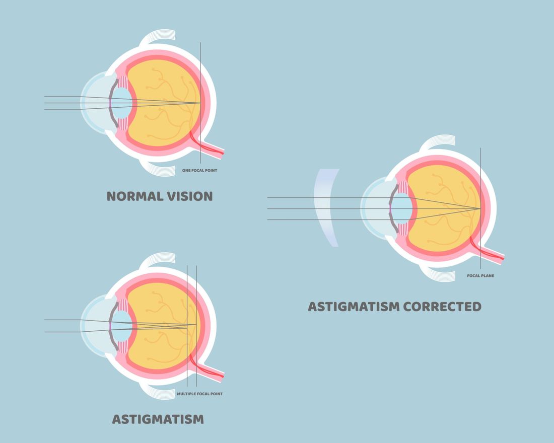 occhio astigmatico