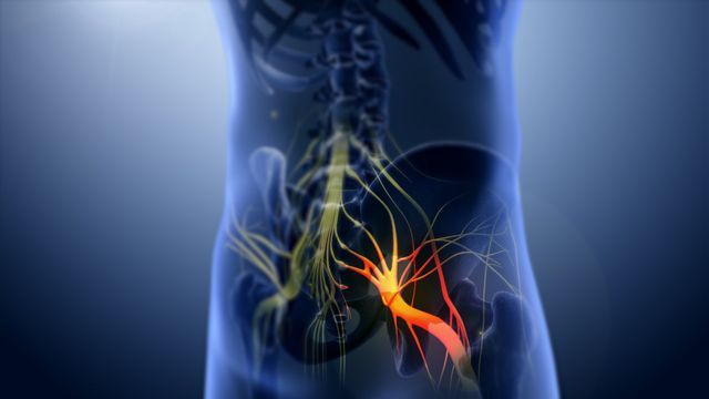 Sciatica Pain: Can a Chiropractor Provide Relief?