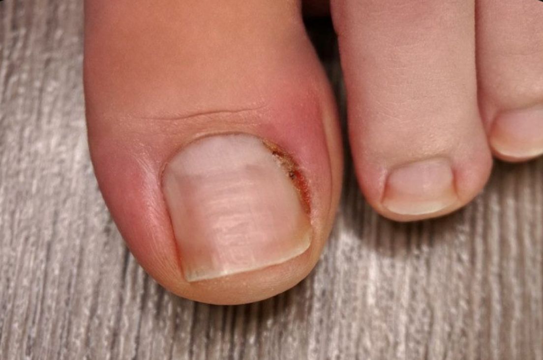 Corte correcto de uñas 