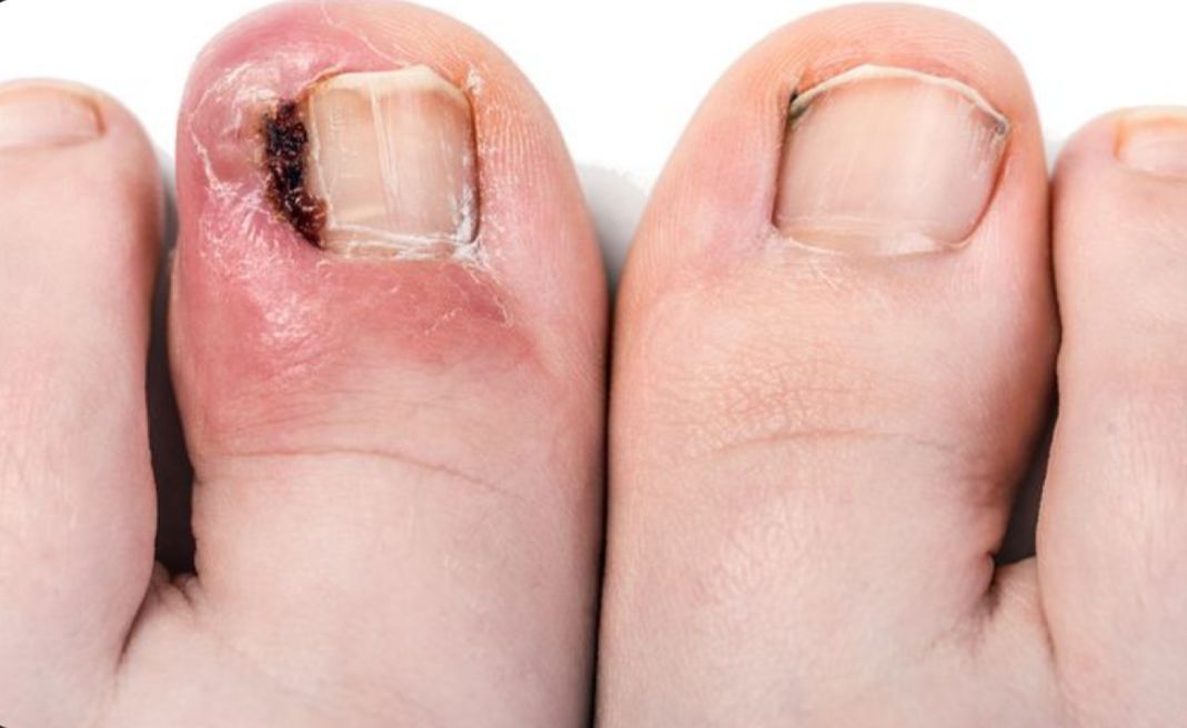 Pedicure uña encarnada