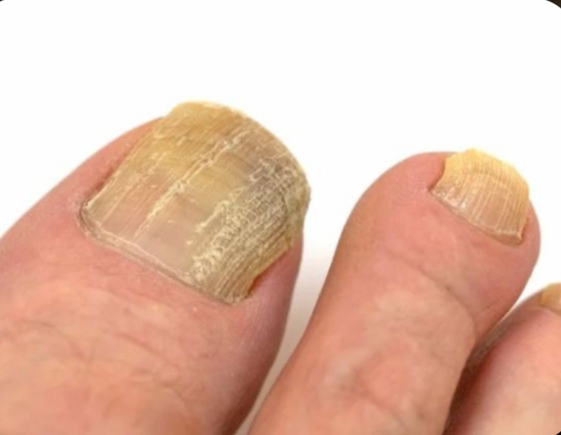 Retiro de callosidades