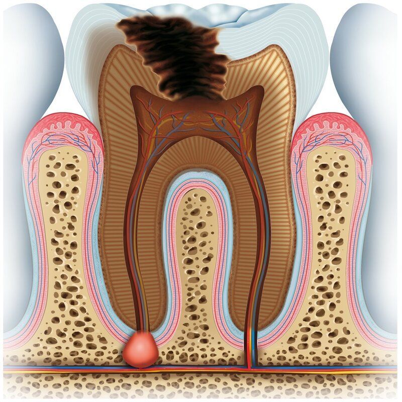 Tann med kraftig utviklet hull