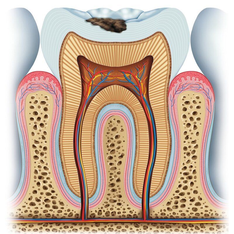 Tann med begynnende hull