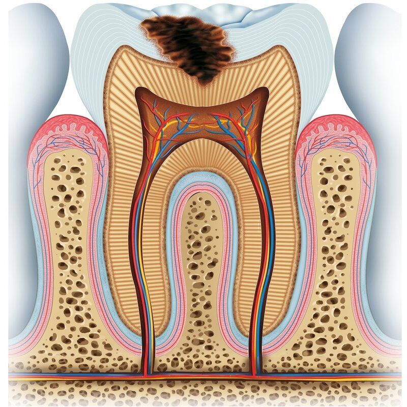 Tann med utviklet hull