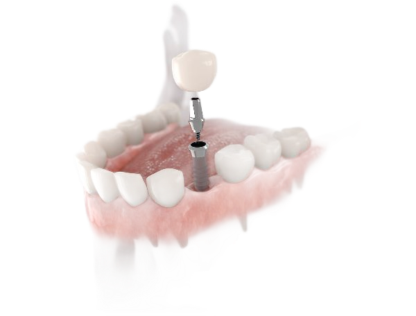 Dental implant model showing a titanium post in the jawbone with a crown being attached.