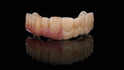Full-Arch Implant Bridge