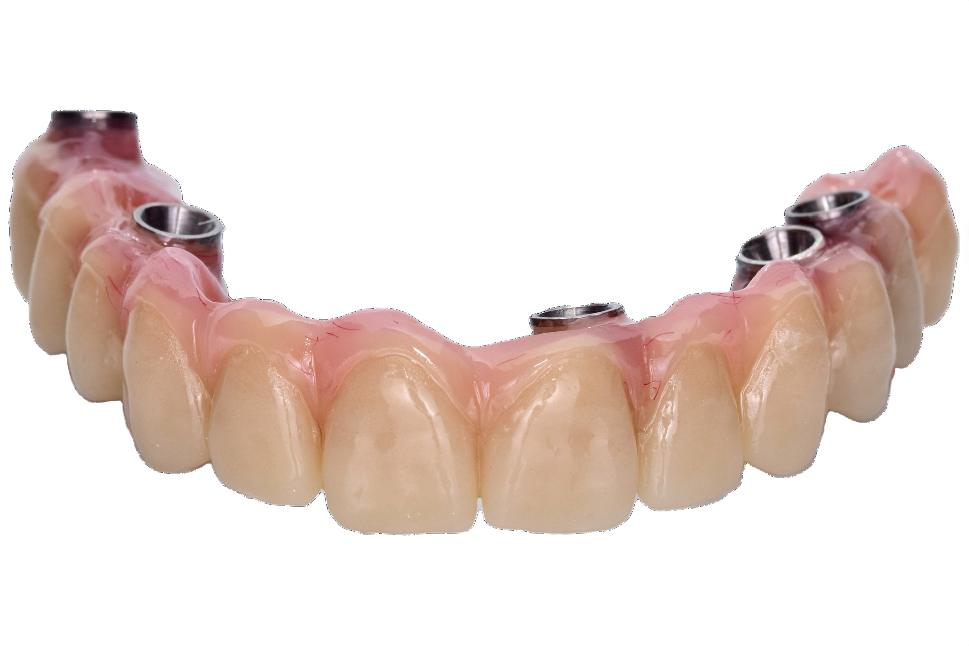 PMMA overdenture