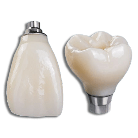 a dental crown and a dental implant