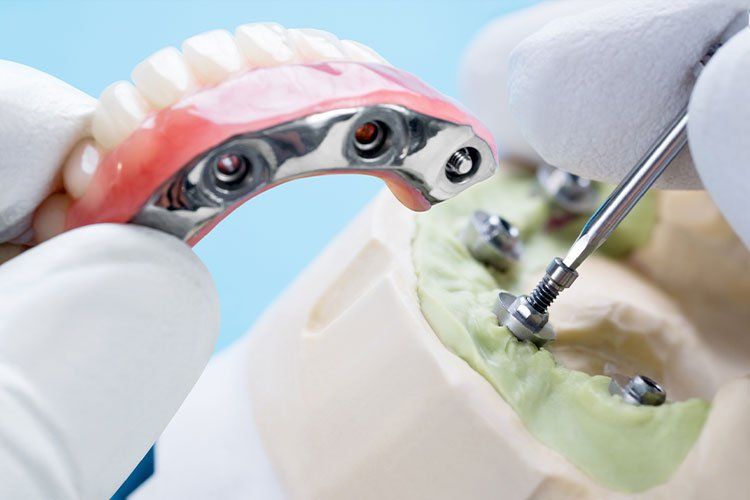 implant surgical planning