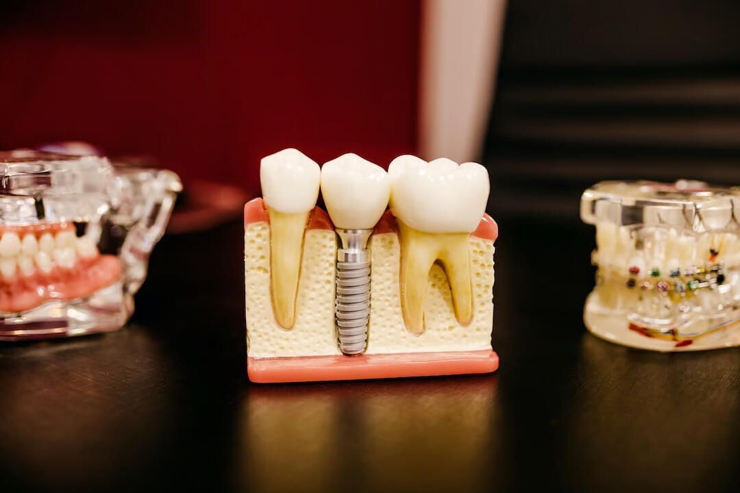 A model of a dental implant sitting on top of a table.