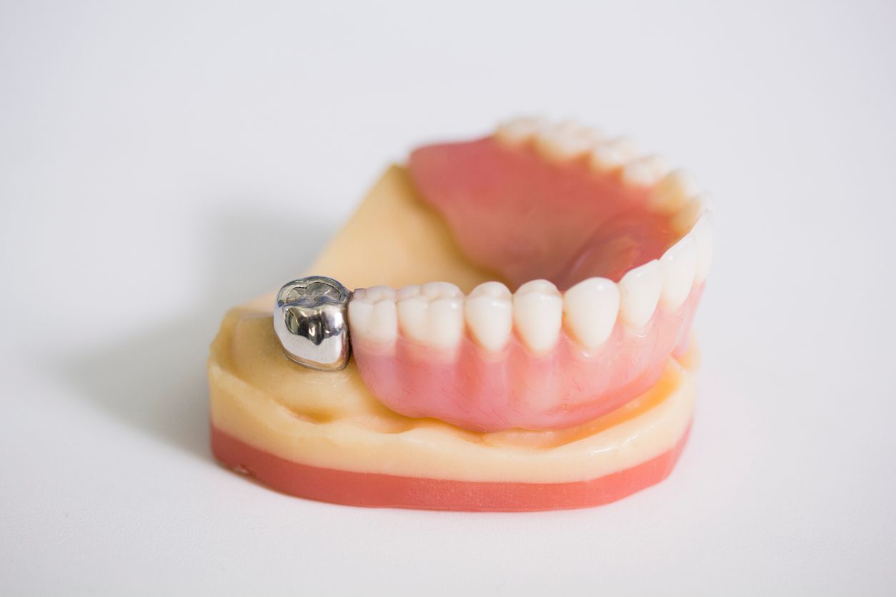 Lower partial denture on a model with pink gums and white teeth, silver clasp.