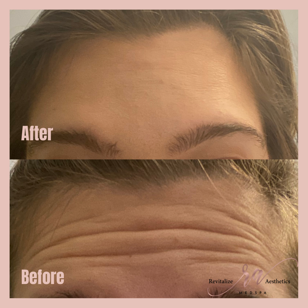 A before and after photo of a woman 's forehead