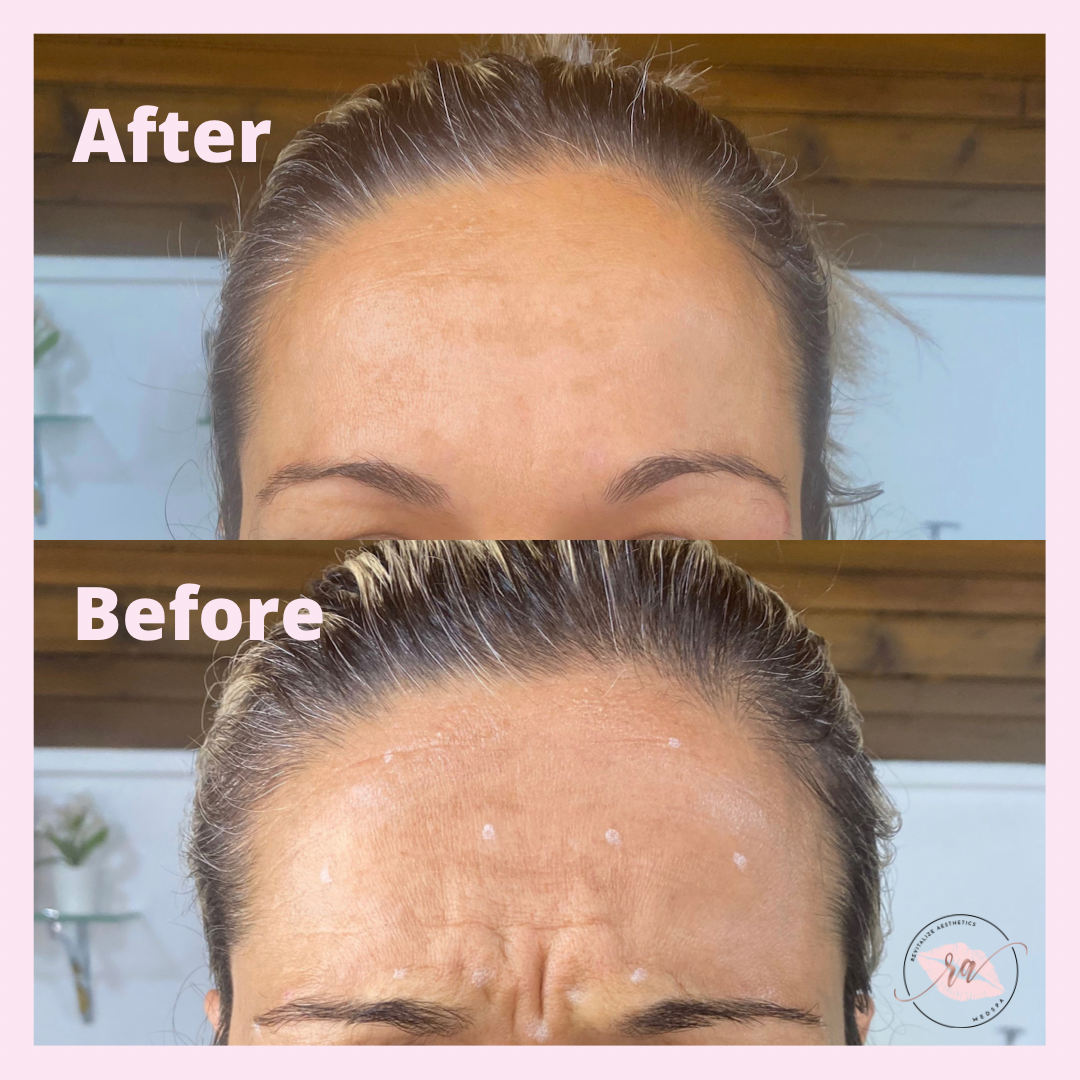 A before and after photo of a woman 's forehead.