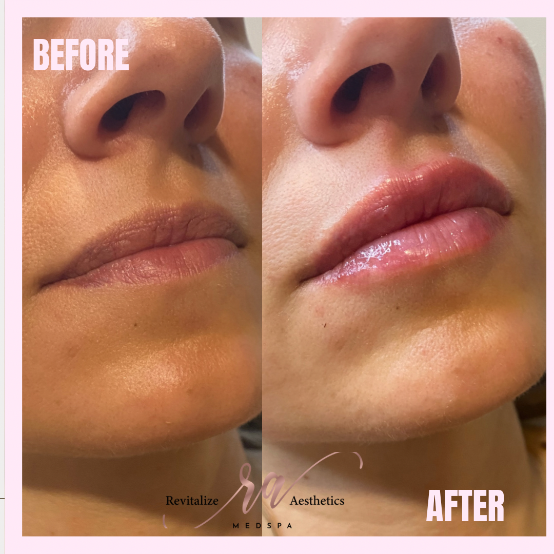 A before and after photo of a woman 's lips.