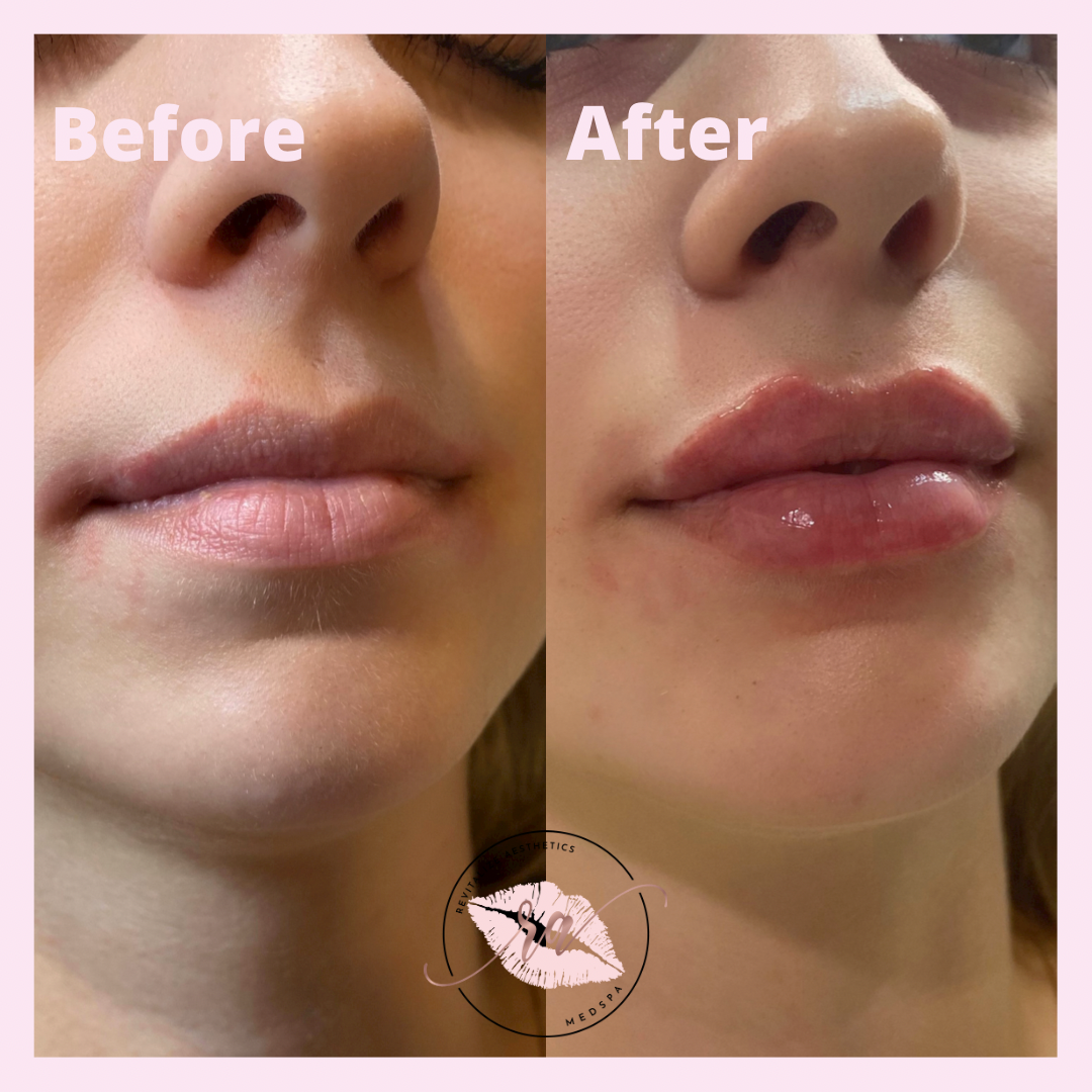 A before and after photo of a woman 's lips.