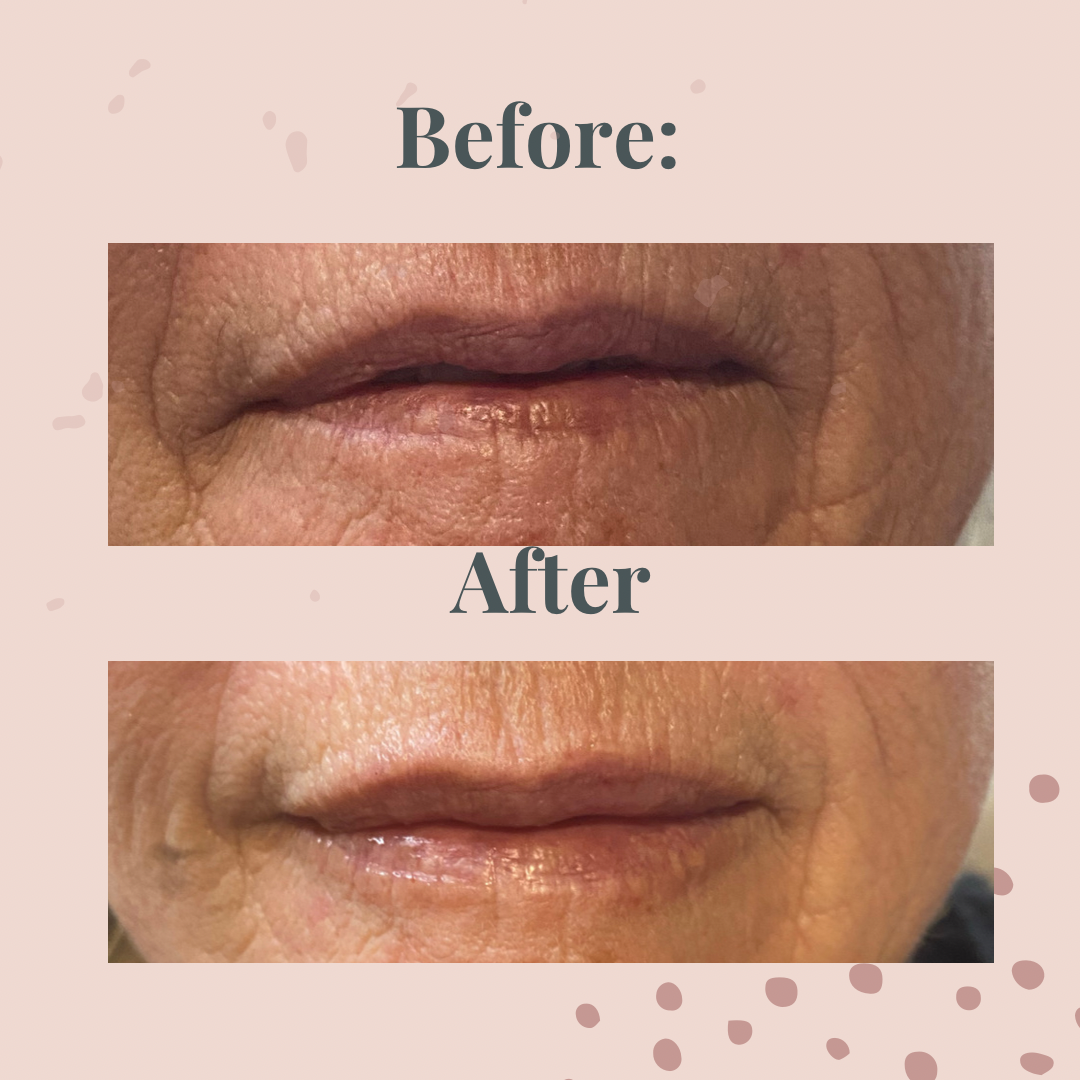 A before and after picture of a woman 's lips.