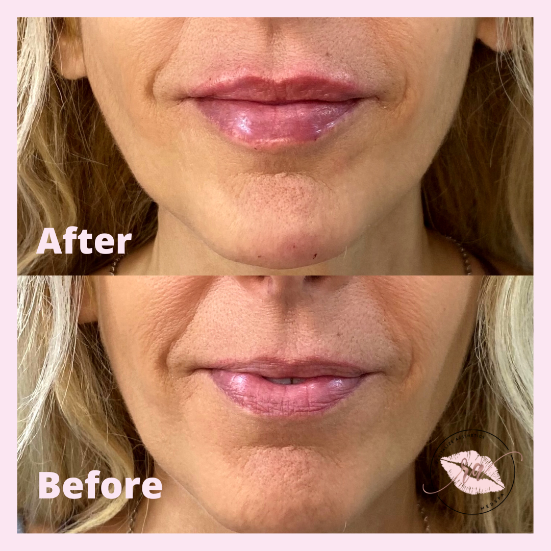 A before and after photo of a woman 's lips.