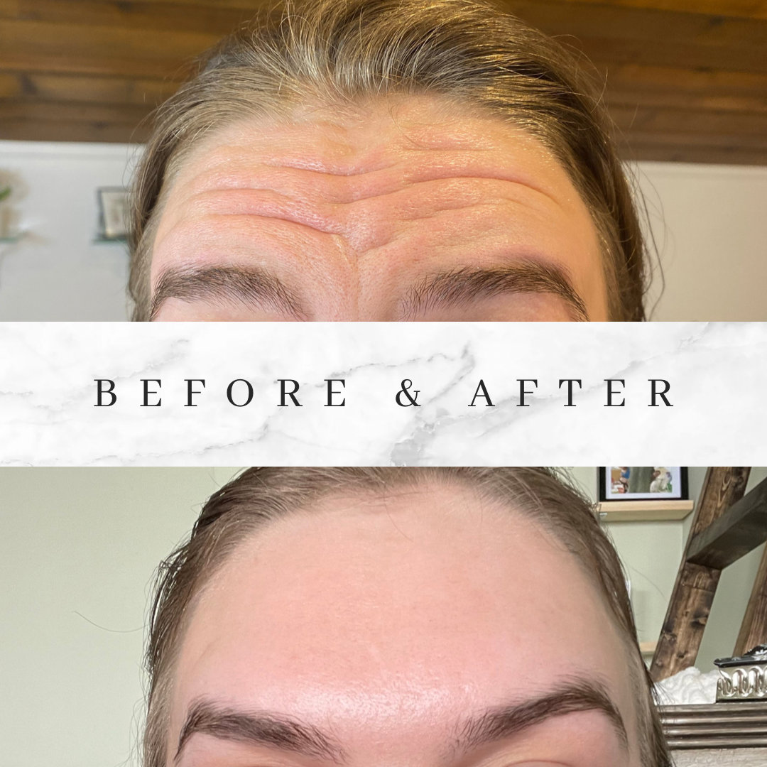A before and after photo of a woman 's forehead.