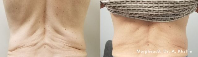 skin concern] will aha help to get rid of the hyperpigmentation on my inner  thighs? : r/SkincareAddiction