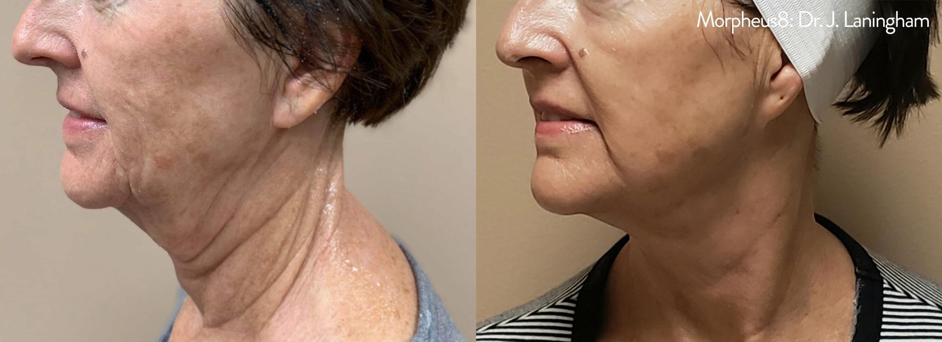 Before & After Morpheus8 Treatment