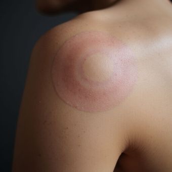 Pink, circular mark on a person's shoulder, likely from cupping therapy.
