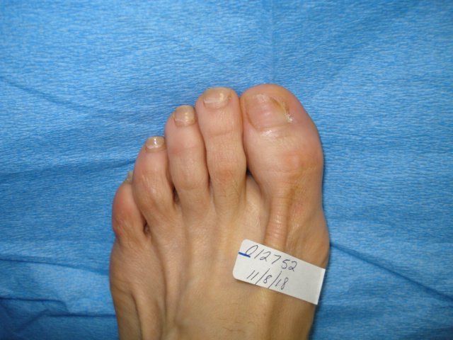 Toenail Fungus After Treatment by Delray Beach Podiatrist
