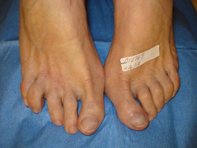 Toenail Fungus After Treatment by Delray Beach Podiatrist