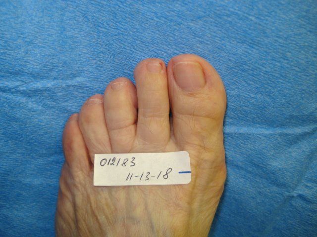 Toenail Fungus After Treatment by Delray Beach Podiatrist