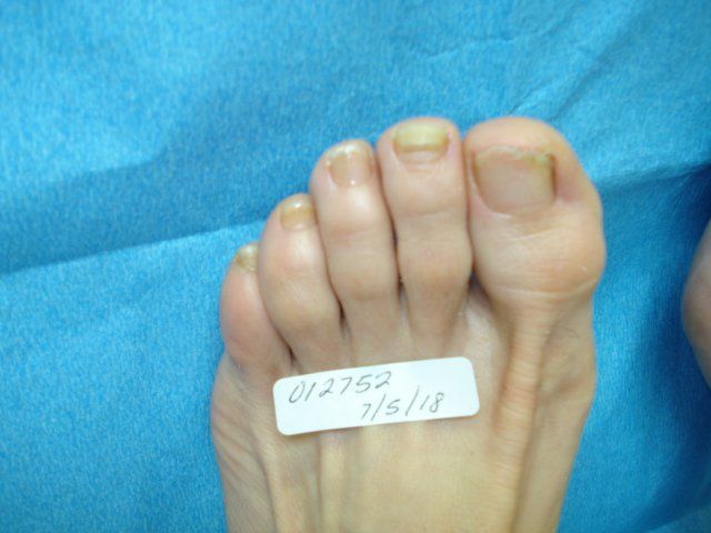 Toenail Fungus Before Treatment by Delray Beach Podiatrist