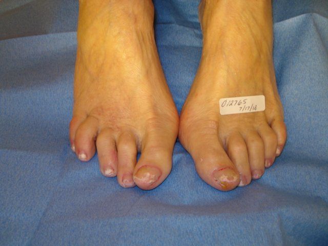 Toenail Fungus Before Treatment by Delray Beach Podiatrist