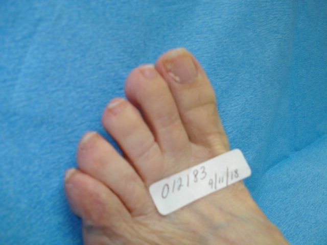 Toenail Fungus Before Treatment by Delray Beach Podiatrist