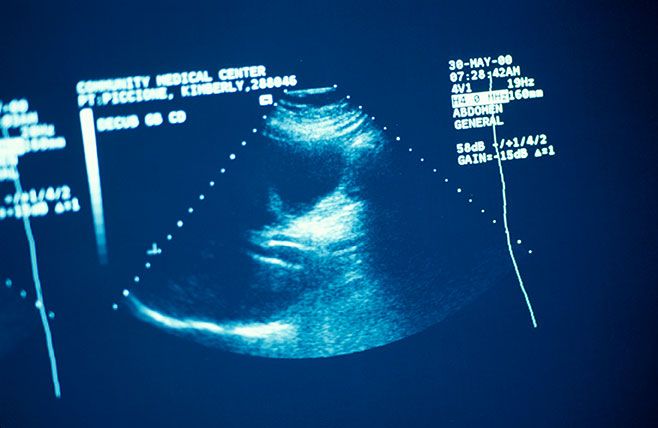 Ultrasonido, para qué sirve un ultrasonido, atención prenatal, biopsias