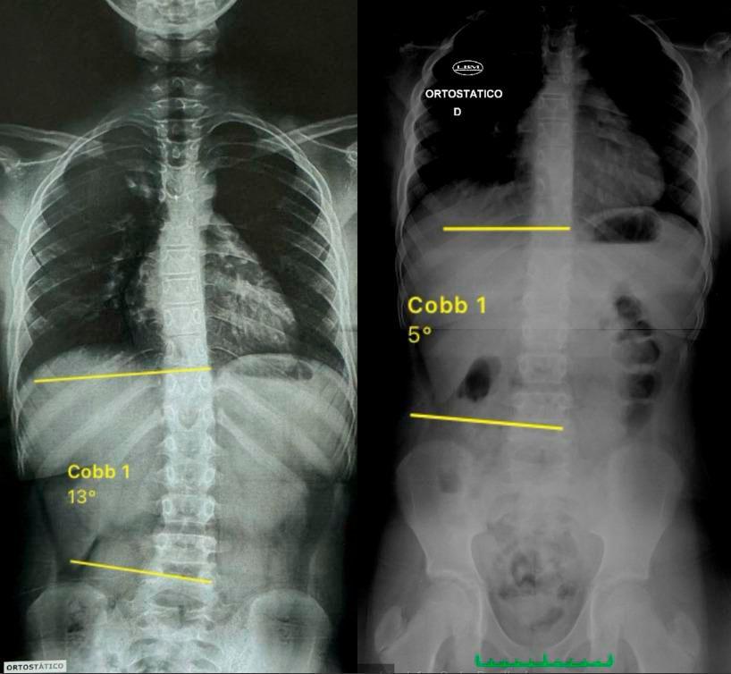 Uma radiografia do tronco de uma pessoa com análise de escoliose.