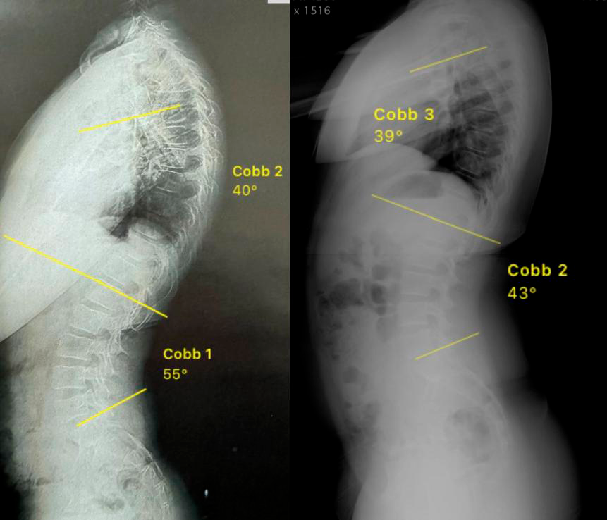 Uma radiografia do tronco de uma pessoa com análise de escoliose.