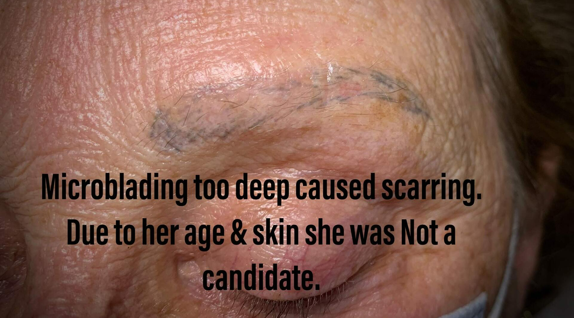 older woman with microblading scar