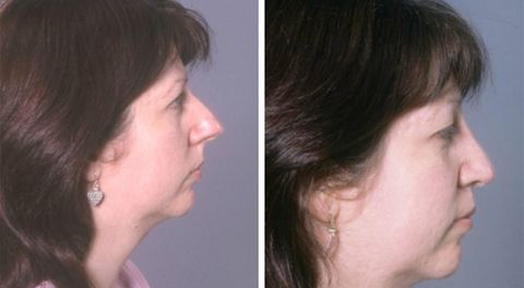 Before and after Rhinoplasty 7
