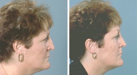 Before and after Rhinoplasty 6