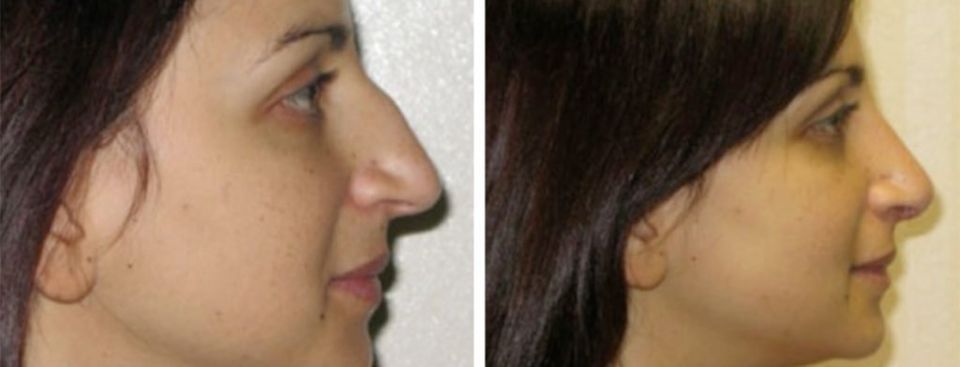 Before and after- Rhinoplasty