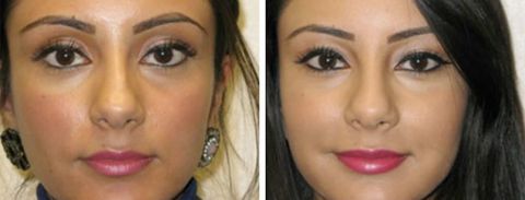 Before and after Rhinoplasty 1