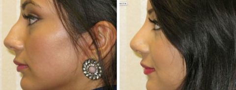 Before and after Rhinoplasty 2