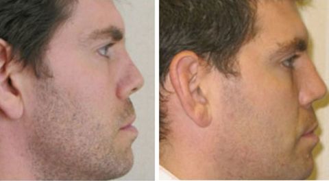 Before and after Rhinoplasty 4